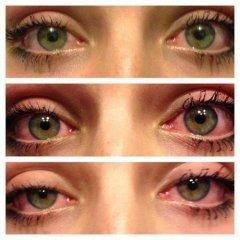 progression Of stoned eyes