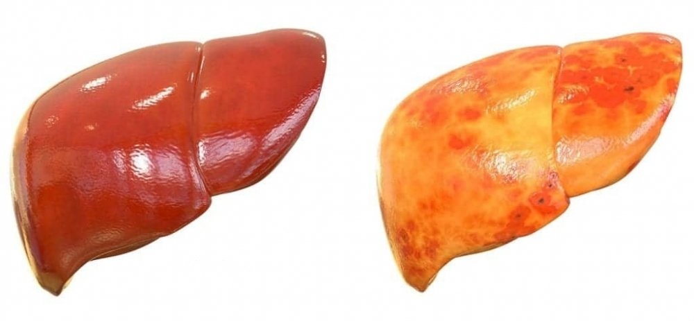 steatosis-liver.jpeg