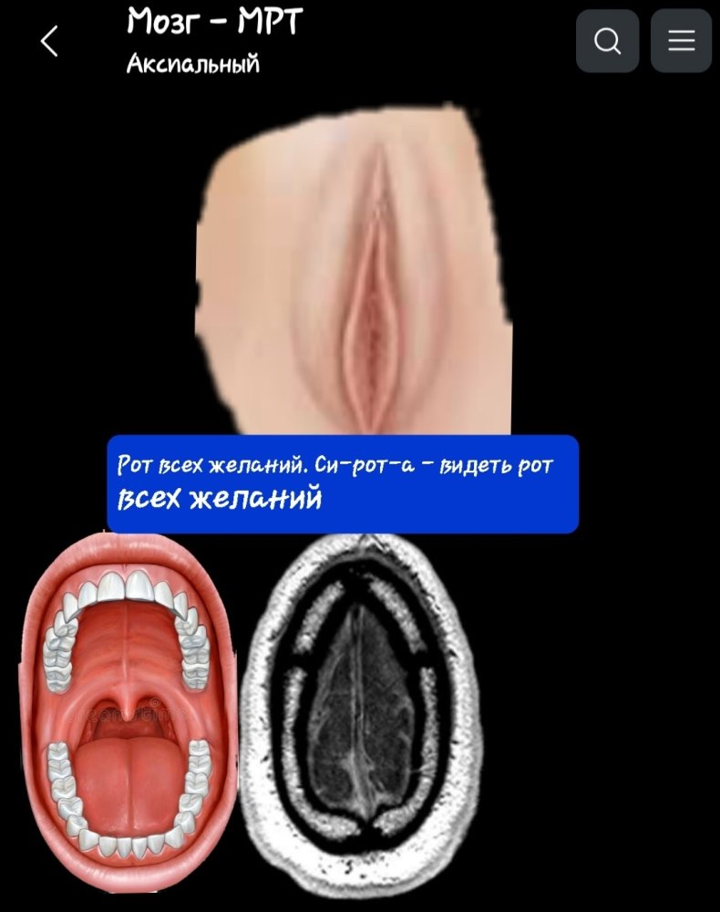 Screenshot_20230825-120212_e-Anatomy.thumb.jpg.eed5e993ebae08f1a849fc5bdb48ebad.jpg