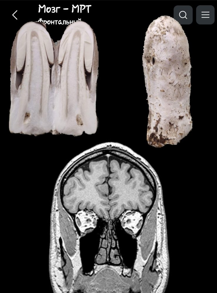 Screenshot_20230825-193542_e-Anatomy.thumb.jpg.a8abdecfeb5d9e4012e84b7294a41b5b.jpg
