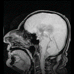 NPH_MRI_272_GILD.gif.c44bd646c84b8e6c57736592239232e4.gif