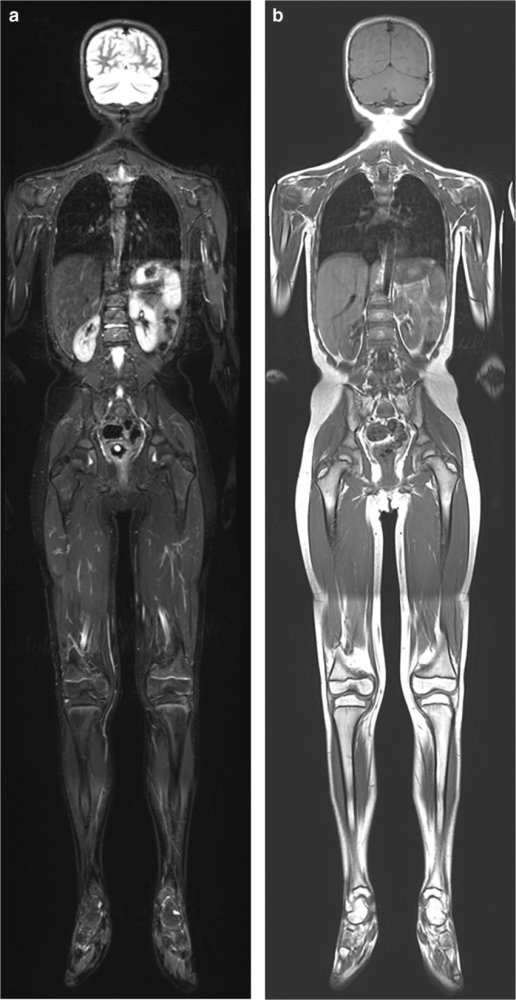 Routine-surveillance-in-a-9-year-old-boy-with-Li-Fraumeni-syndrome-a-b-Coronal-a.thumb.png.53cd443e269448567eae0e87700b389d.png