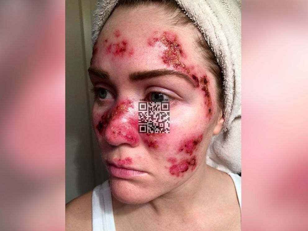 melanoma.jpg
