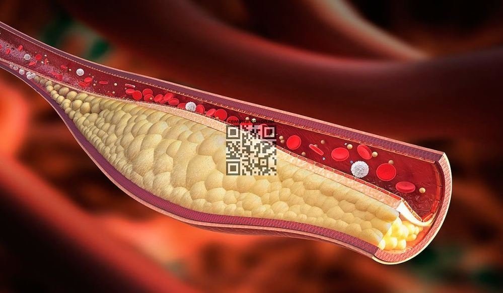 atherosclerotic-plaque.jpg