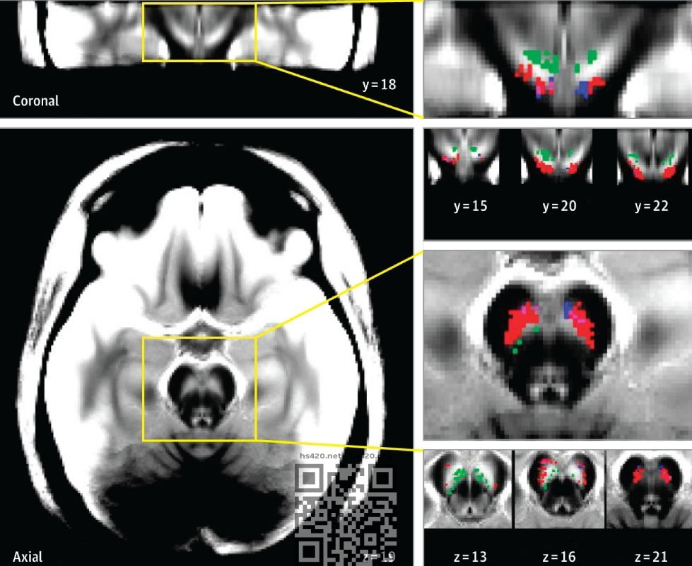 mri-cannabis-users-neuromelanin.jpg